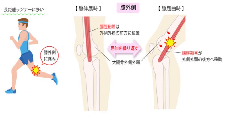 腸脛靭帯炎（ランナー膝）