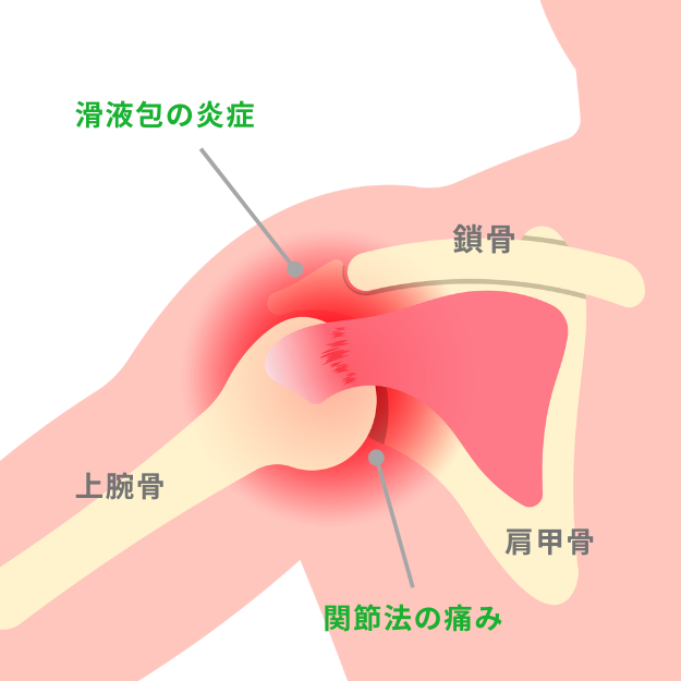 五十肩